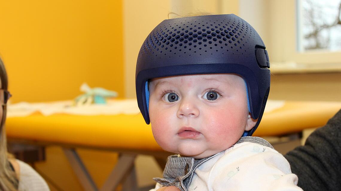 Säugling mit Kopfkorrektur-Helm von Talee aus 3D-Drucker Säugling mit Helm aus dem 3D-Drucker von Talee zur Kopfkorrektur