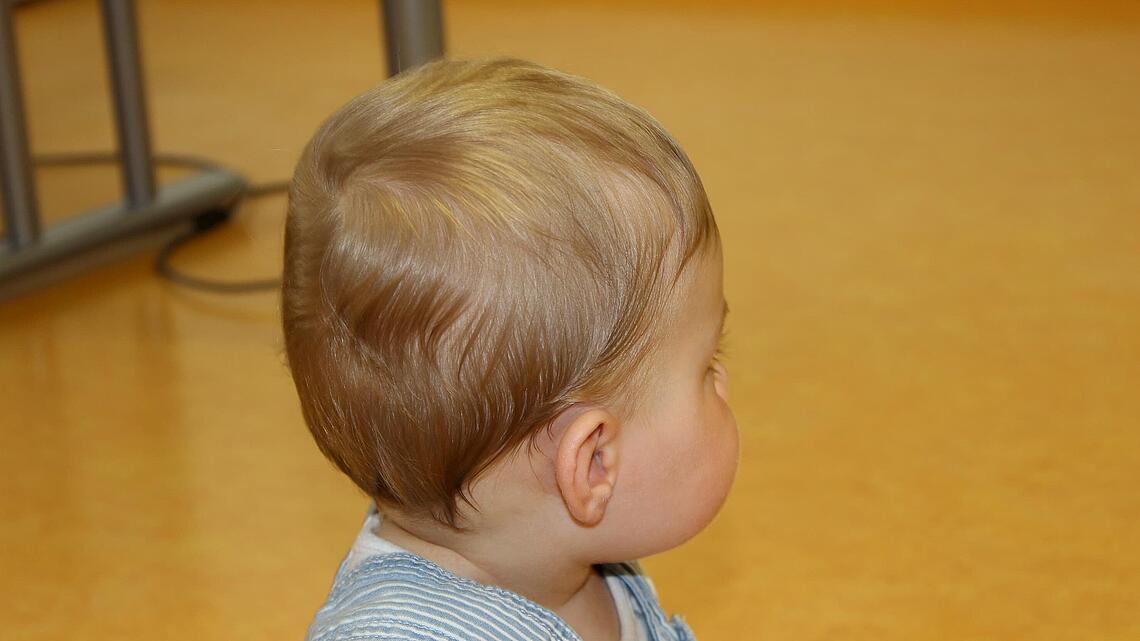 Korrigierte Schädelform eines Säuglings nach einer Helmtherapie Korrigierte Schädelform eines Säuglings als Ergebnis einer erfolgreichen Helmtherapie