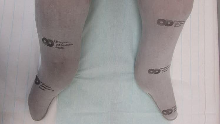 Bein-Liner Liner auf Beinstümpfen für eine optimale Verbindung zur Prothese