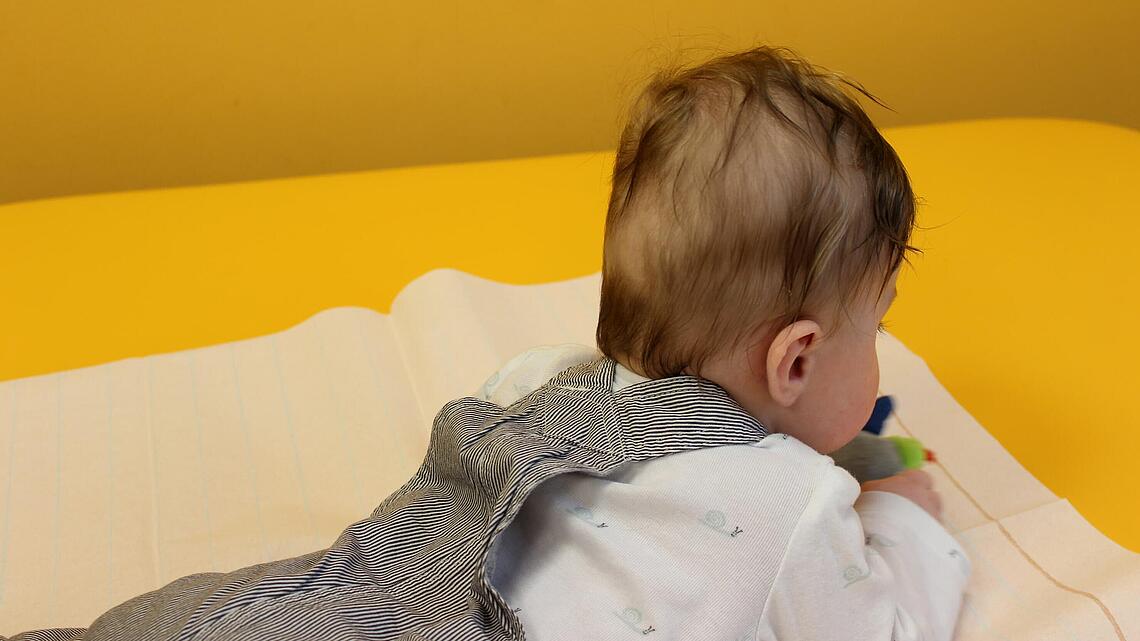 Säugling mit abgeflachtem Hinterkopf Säugling mit Schädeldeformität in Form eines abgeflachten Hinterkopfs