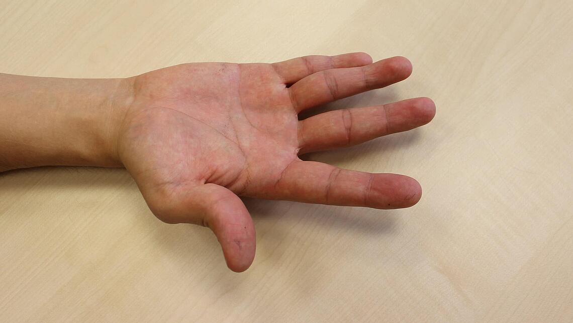 Fingerfehlstellung Fehlstellung der Finger als Ausgangspunkt für den Einzatz einer Ulnardeviationsorthese