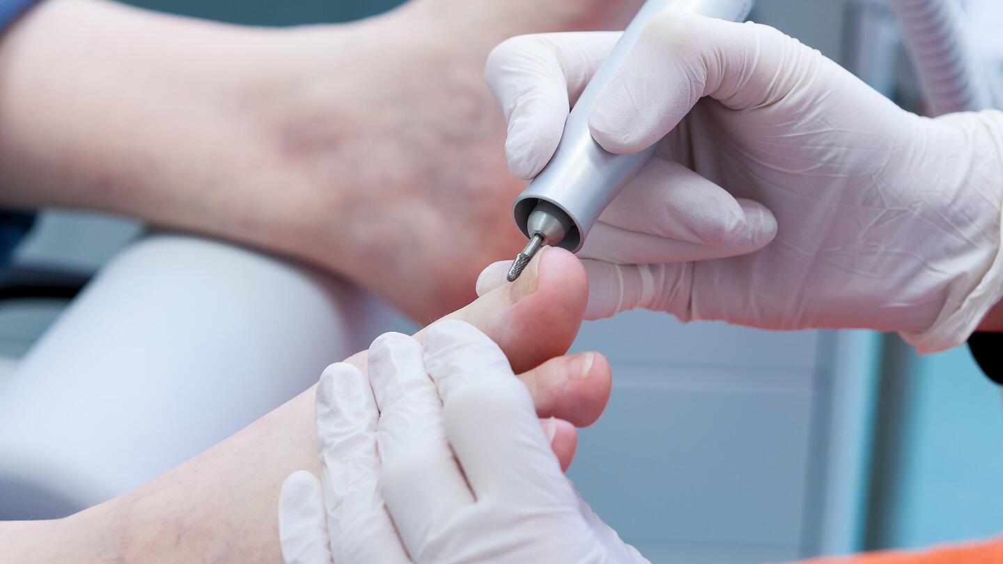 Fußnagelfeilen in der Podologie Feilen eines Zehennagels mit elektrischer Feile in der Podologie