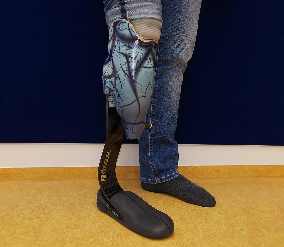 Unterschenkelprothese mit gedrucktem Cover Unterschenkelprothese mit gedrucktem blauen Cover