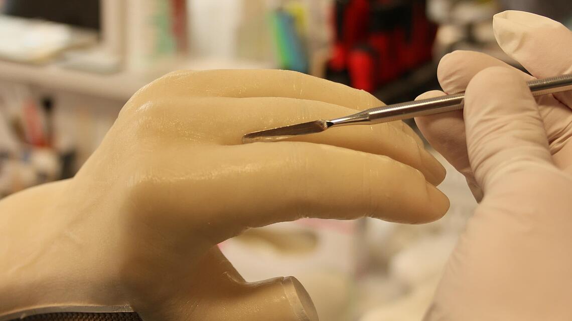 Formung der Finger einer Unterarmprothese Formung der Finger einer Unterarmprothese mit Spatel