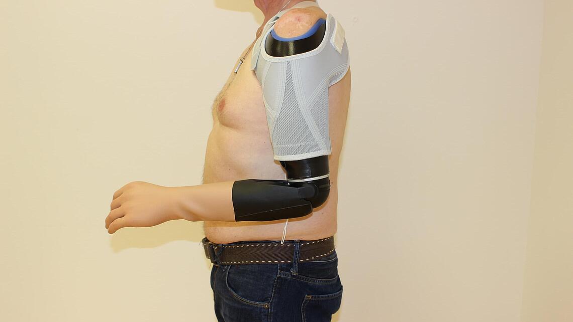 myoelektrische Oberarmprothese angezogen myoelektrische Oberarmprothese angezogen